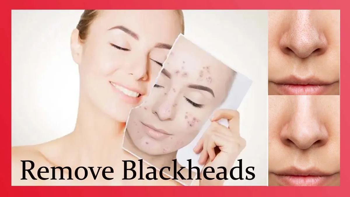 முகத்தில் இருக்கும் Blackheads  உங்கள் அழகை கெடுக்கிறதா? இதோ 2 மினிட்ஸ் டிப்ஸ் உங்களுக்காக 
