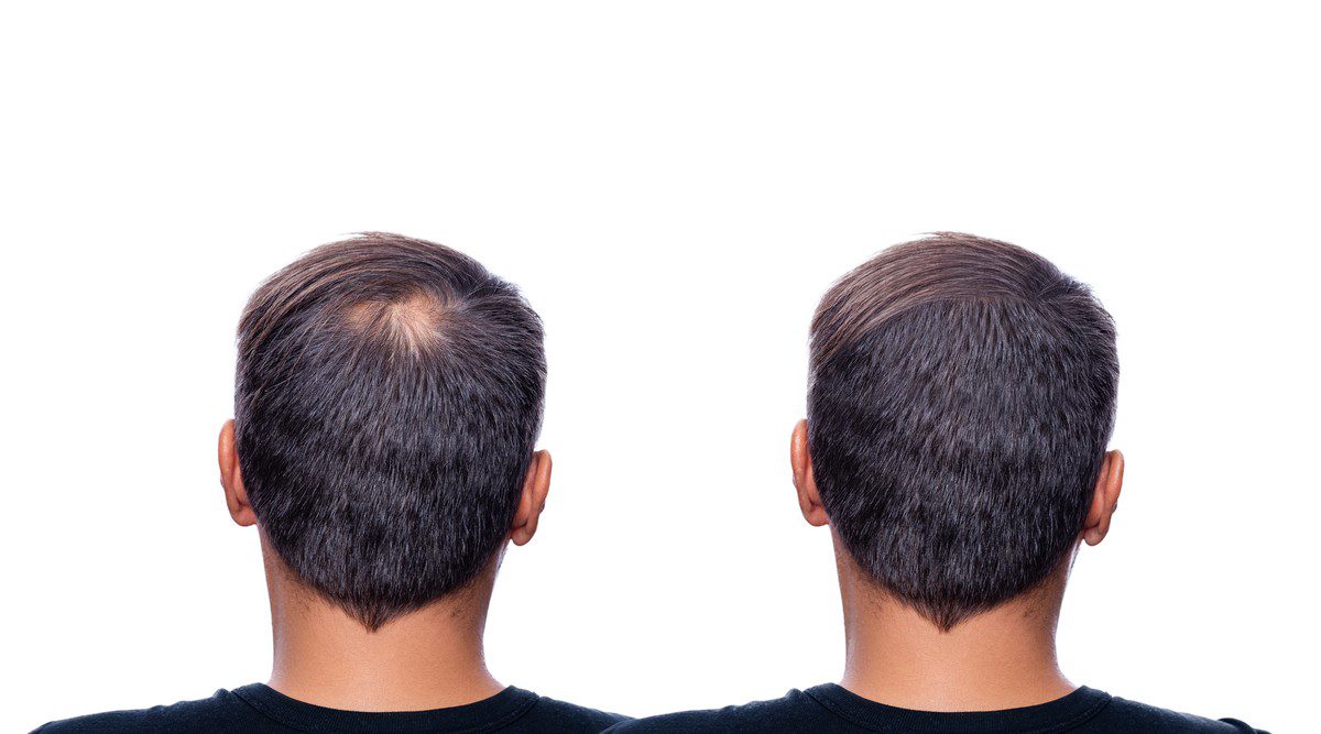 3 Best Hair Regrowth Tips
