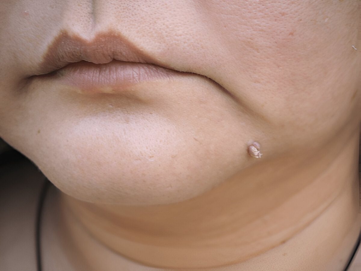 how-to-remove-warts-naturally-in-tamil