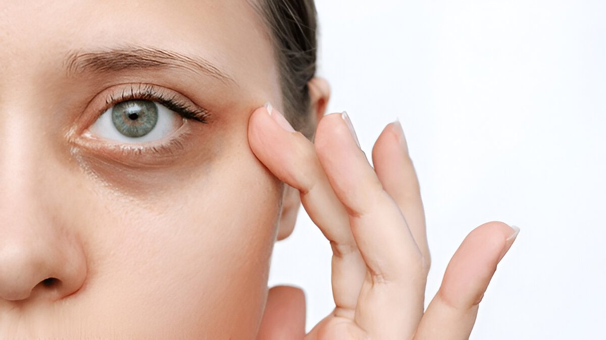 Best remedies for dark circles under eye in tamil